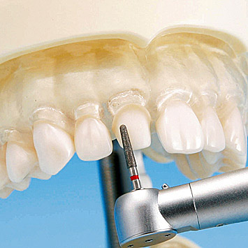 Crown & Bridge Area | Prosthetic Restoration Jaw Model (32 teeth ...