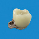 PFM Crown with Ceka Connecting Unit