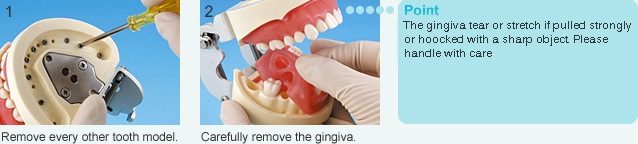 How to remove the gingiva